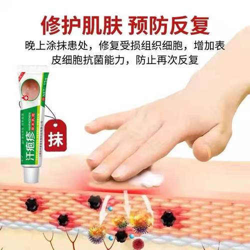 汗泡疱疹药膏手上起小水泡汗状疱疹止痒汉状真菌感染手气专用软膏 - 图2