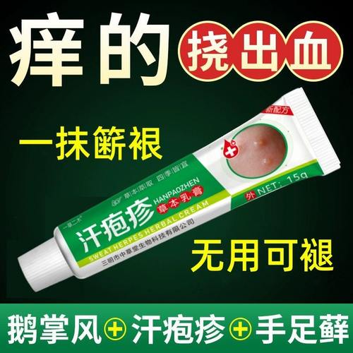 汗泡疱疹药膏手上起小水泡汗状疱疹止痒汉状真菌感染手气专用软膏 - 图1