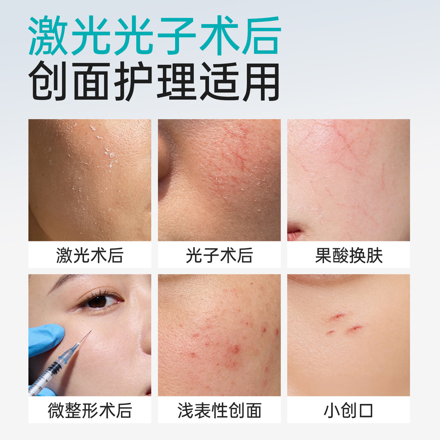 超亚医用透明质酸钠冷敷贴医美术后补水敏感肌祛痘印修复非面膜