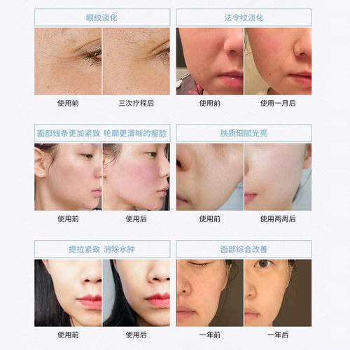 360度水光仪美容仪器脸部提拉紧致除皱波拉皮吉脸拉提瘦脸热玛 - 图3