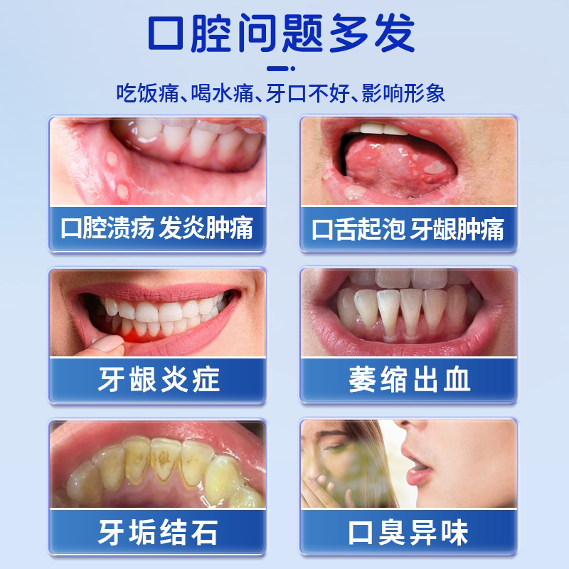 口腔溃疡喷剂舌头溃疡嘴上火起泡喷雾口腔溃疡口舌生疮专用非贴