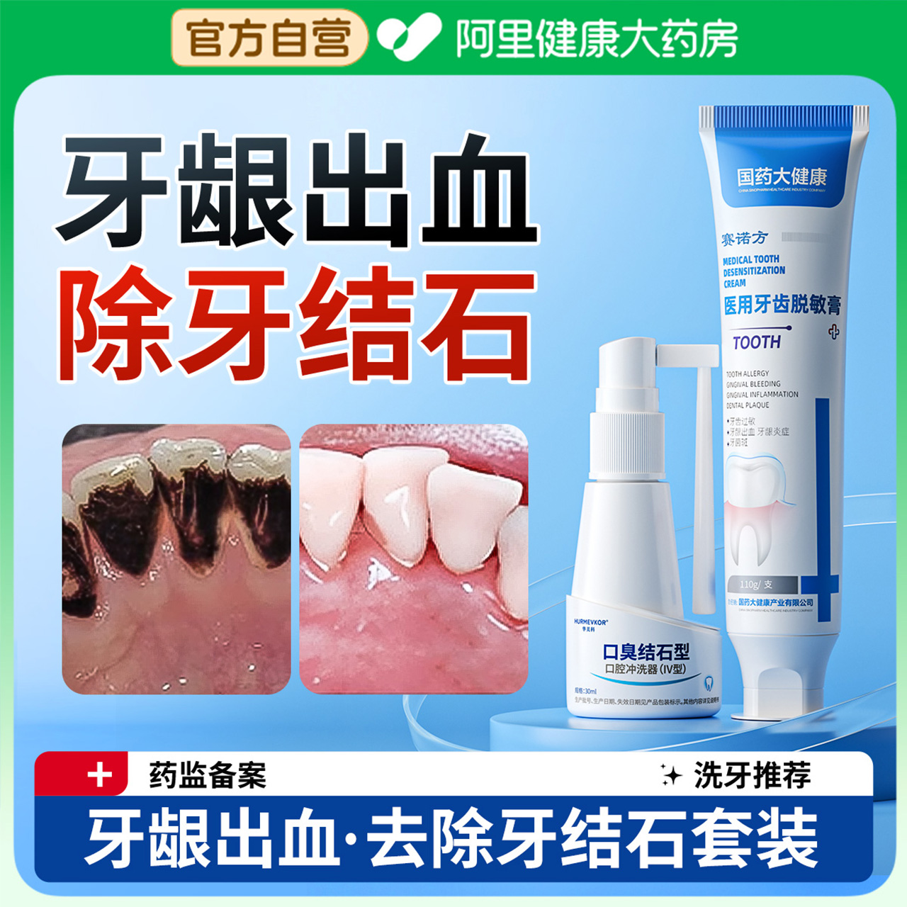 医用牙膏牙结石去除器专用抗敏美白速效去牙渍牙垢黄牙除口臭神器 - 图0