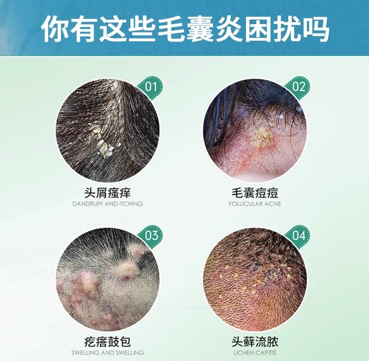 头皮毛囊炎特效发外阴头上后背脸上痤疮背部长痘痘非药溢脂性软膏 - 图0