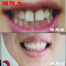 The invisible braces of the teeth.