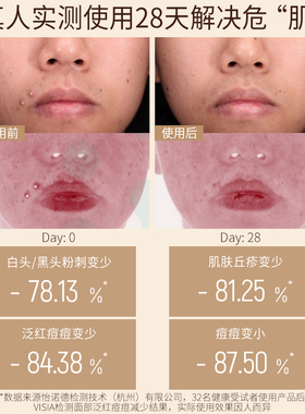 老中医祛痘淡印闭口粉刺套装