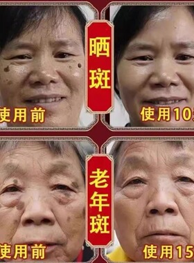柔迪脱皮美白祛斑霜王去黄褐斑雀斑淡化色斑官方旗舰店正品第一名