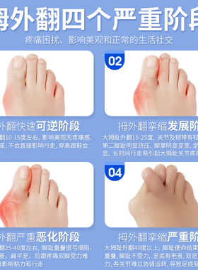ober脚拇指头改善男女脚趾矫正器