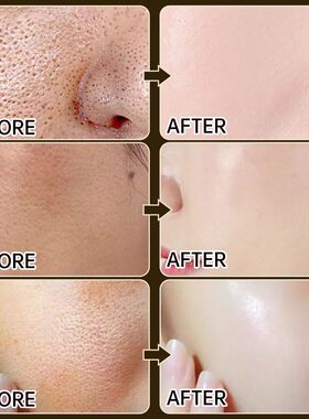 Mildest %2 Salicylic Acid Shrink Pore Face Serum Acne Blackh
