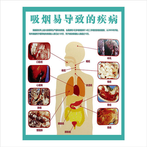 禁烟宣传海报挂图墙贴禁止吸烟戒烟吸烟有害健康宣传画标语牌贴纸 - 图0