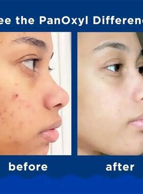 4%/10% Acne Foaming/Creamy Face Wash With Benzoyl Peroxide