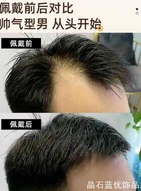 精致发际线贴发际线假发贴男前假发贴补发片隐形无痕鬓家用收纳