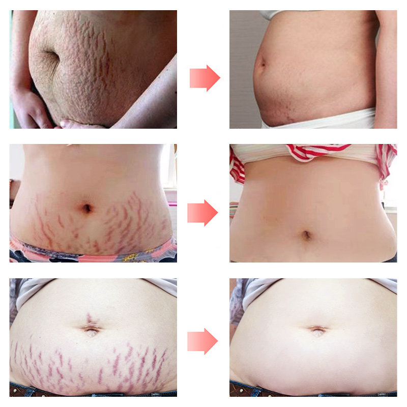 米雅诗橄榄精华油淡化预防妊娠产后纹专用护理油身体滋润护肤品,淘宝优惠券,粉丝福利购,淘宝优惠卷