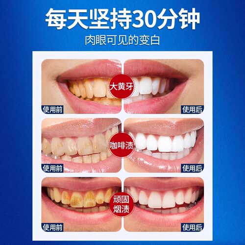 牙贴牙齿美白去黄洁白速效洗白变白神器5d5D牙贴片临时遮盖门牙渍 - 图0