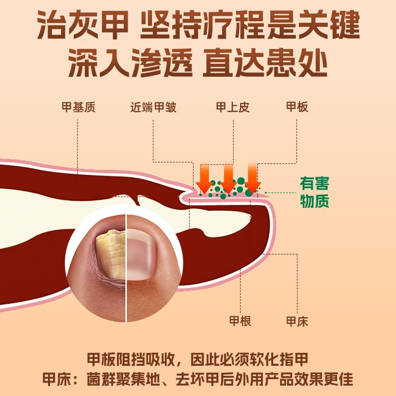 灰指甲甲沟炎专用抑菌液去灰甲液脱甲软甲膏抗菌修脚正品旗舰店 - 图3