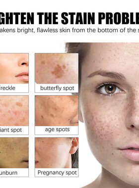 Whitening Freckles Cream Remove Melasma Dark Spot Lightening