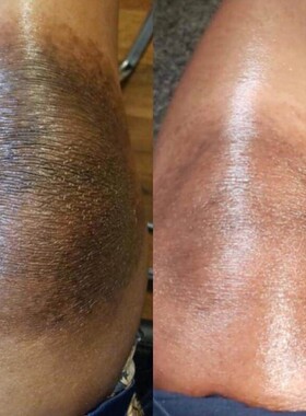 100ml Orange Peeling Gel Bleaching Knee Armpit Dark Spots Bl