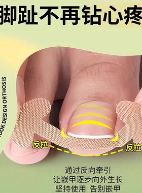 甲沟神器指甲矫正器隔离脚趾甲长肉里填充垫片纠正炎嵌甲专用拉贴