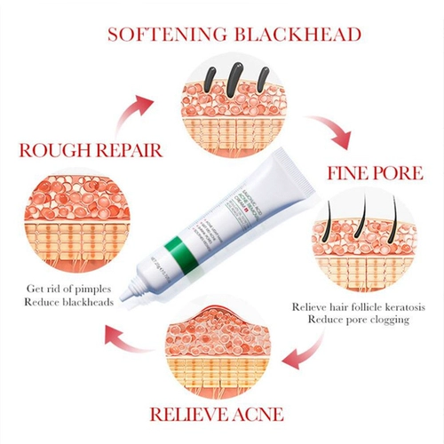 20 гс ali cy cac id Удаление угрей Установка