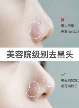 美容院黑头导出液30ml溶解酒糟鼻草莓鼻粉刺收缩毛孔深层清洁