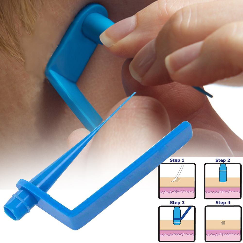 Blue Set Skin Tag Removal Kit Home Use Mole Wart Remover Equ - 图2