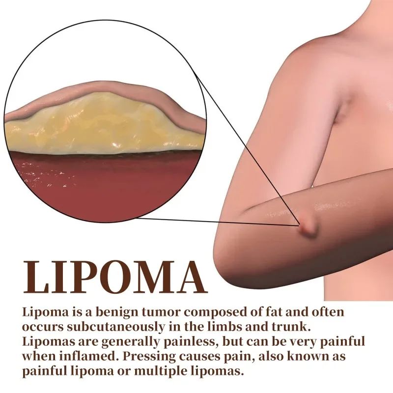 Lipoma Cream Subcutaneous Lumps Remover Treatment Medicine L - 图1