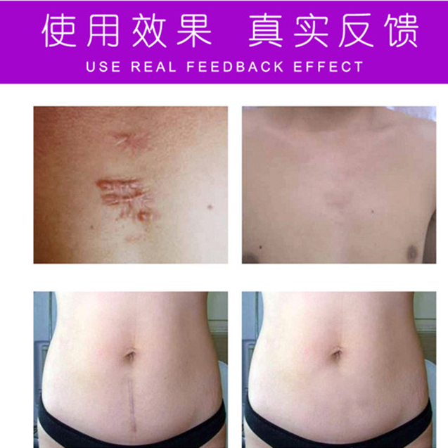 草本祛黑色素沉着回流色素印痕霜淡化抓痕黑印红印产品正品药膏贴,淘宝优惠券,粉丝福利购,淘宝优惠卷