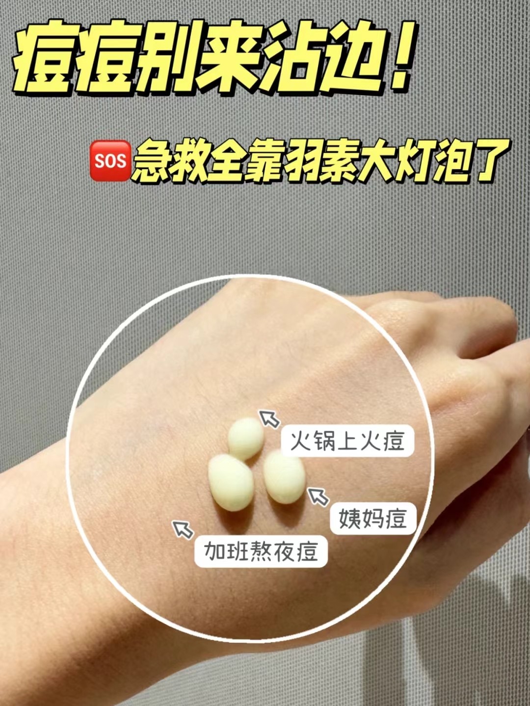 羽素大灯泡祛痘精华液Ⅱ胶态硫退红去闭口粉刺舒缓控油改善痘肌,淘宝优惠券,粉丝福利购,淘宝优惠卷