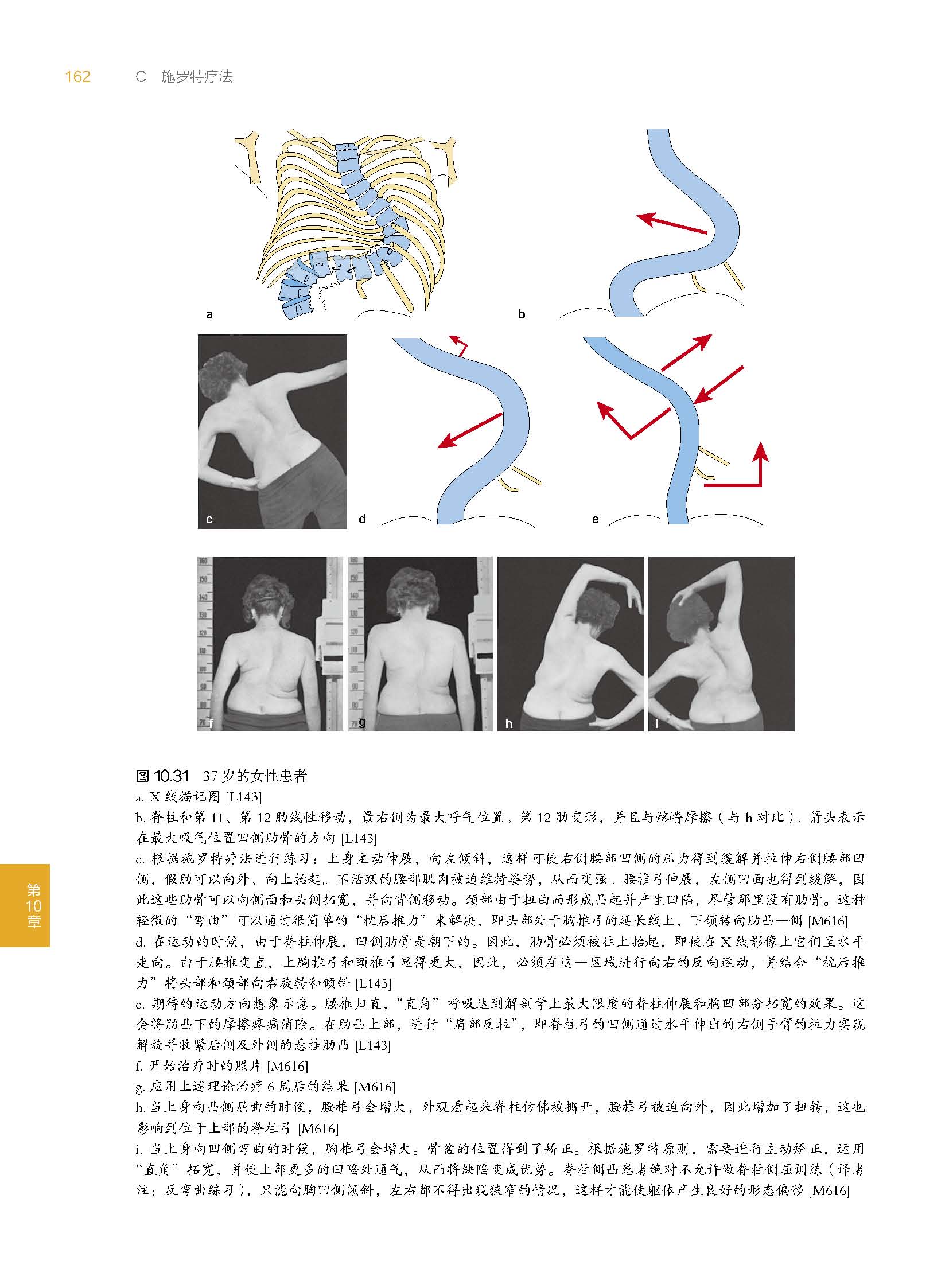 施罗特脊柱侧凸三维治疗第9九版德国脊柱侧凸非手术疗法金标准施罗特疗法的训练策略介绍系统科学的脊柱侧凸矫正体系外科学-图3