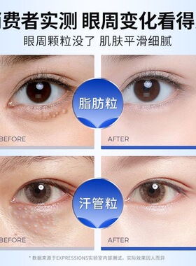 Expressions爱碧生眼霜去脂肪粒汗管瘤淡化黑眼圈去油脂粒眼男女