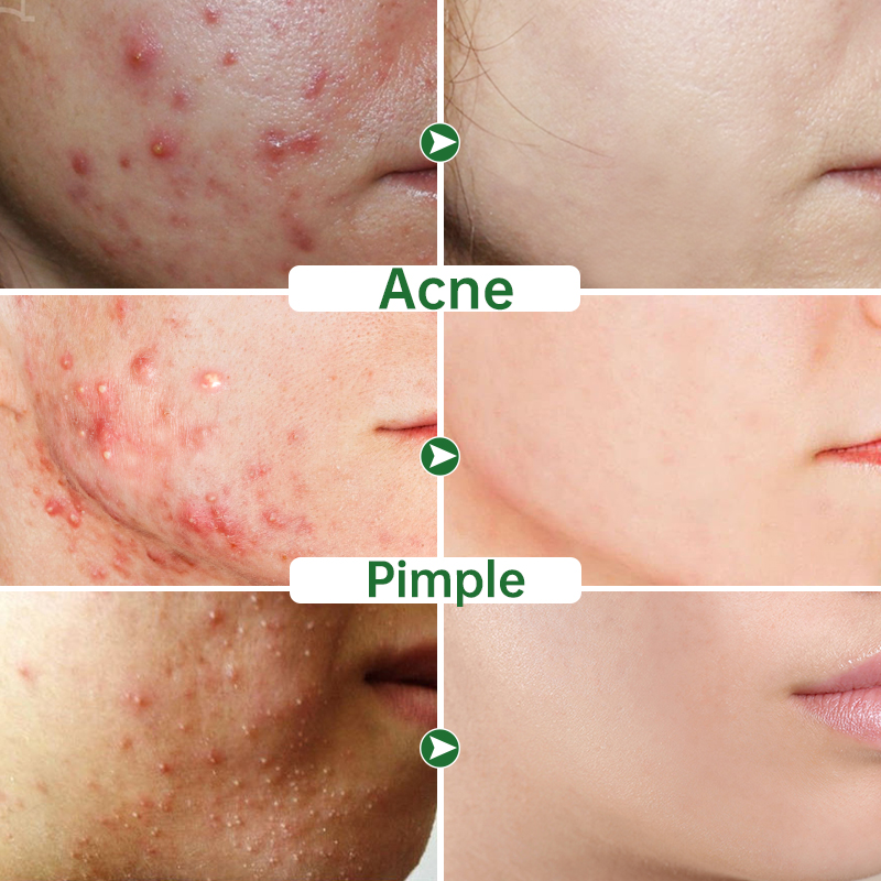 Acne Face Cream Herbal Pimple Scar Removal Shrink Pore Oil C - 图0