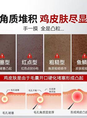 日本京都鸡皮肤疙毛囊角化瘩去角质身体霜乳磨砂膏身体嫩白全身美