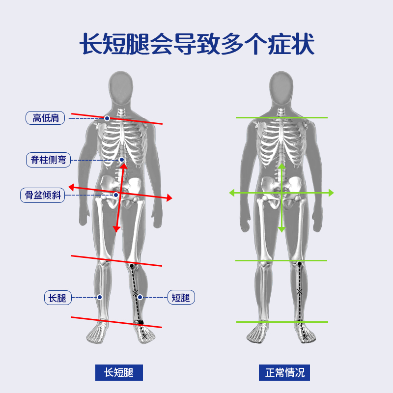 长短腿矫正鞋垫高低脚补高脊柱侧弯骨盆前倾高低肩调节下肢不等长 - 图0