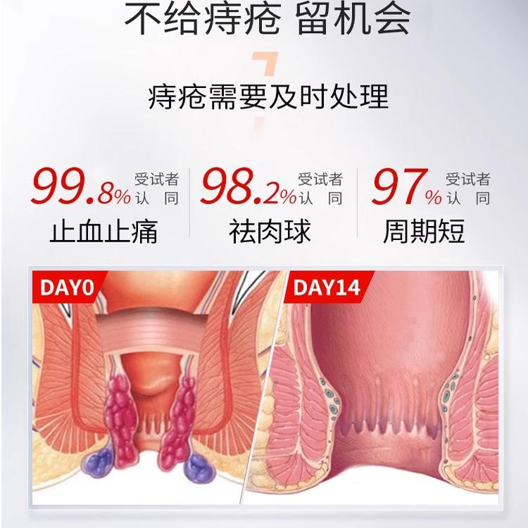 痔疮膏消肉球肛门消痔软膏女性断痔膏卡波姆痣疮冷敷凝胶官方正品