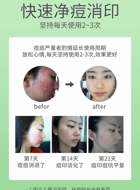 冰王芦荟清痘膏舒缓闭合性粉刺去青春痘淡化痘印黑头痘痕男女正品