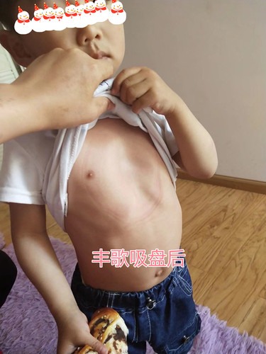 青岛丰歌漏斗胸矫正器负压吸盘儿童款中国专利七天试戴厂家直销 - 图1