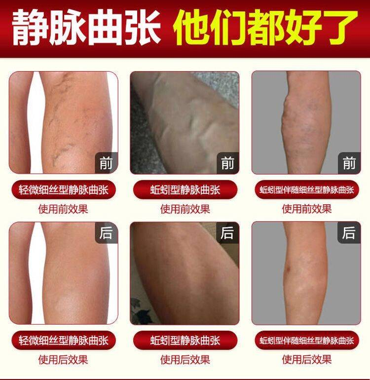 脉舒宝SPRAY脉喷剂舒宝正品【来和】喷剂蚯蚓腿-图0