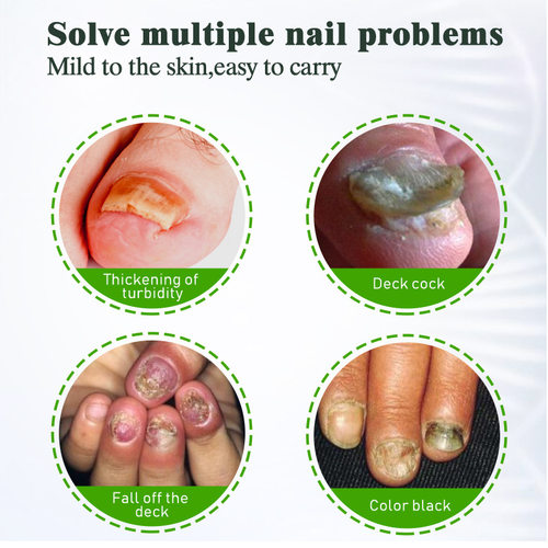 Nail Fungus Cream 20g指甲膏 ebay Lazada Joom跨境热销Shopee - 图1
