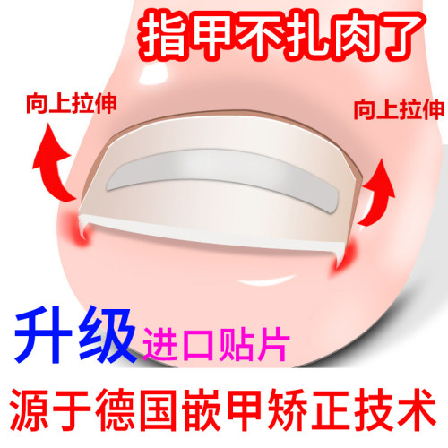 德国嵌甲矫正贴片正甲贴弹力贴拉拉贴胶水甲沟疼BS贴片炎修脚套装 - 图0