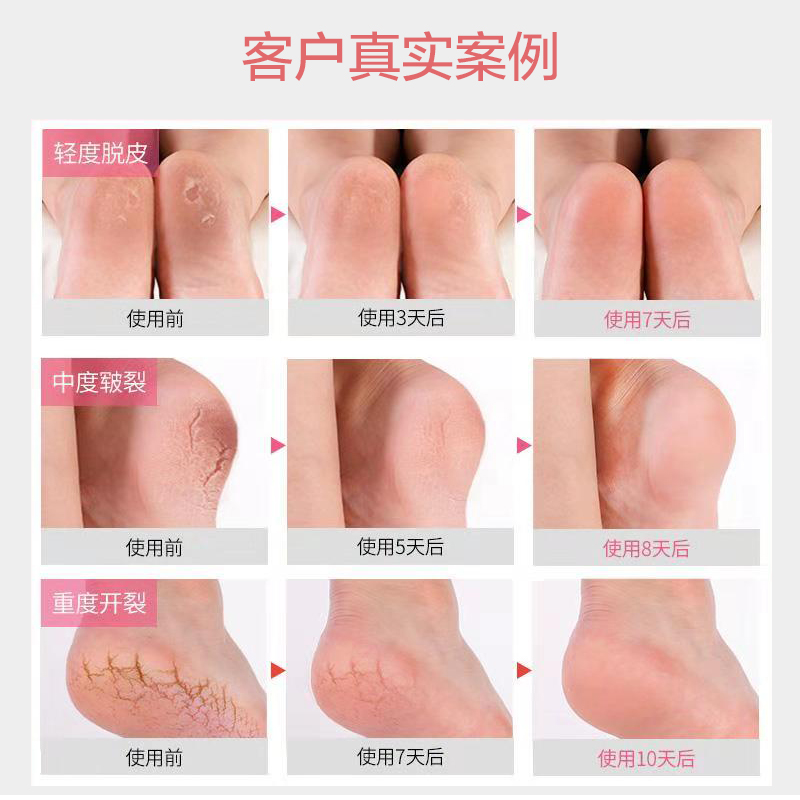 南极人有旺专卖店南极人防裂袜子女士足跟套硅胶保护脚后跟足裂套保护套防干裂棉袜2