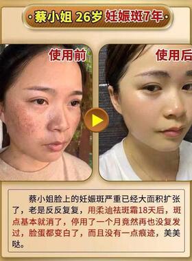 柔迪祛斑王正品官方旗舰店淡化色斑美白祛斑霜膏祛黄褐雀斑会脱皮