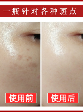 祛斑液分解黑色素不脱皮无尴尬期美容院去雀斑黄褐斑淡斑精华液