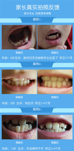 儿童牙齿矫正器牙套夜间防磨牙反颌整牙神器隐形龅牙地包天纠正器 - 图0