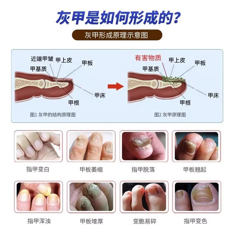 灰指甲打磨机器电动磨甲器硬脚趾甲修甲专用工具锉刀老人灰厚指甲 - 图2