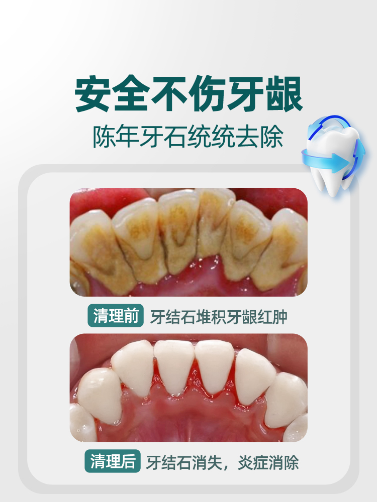 牙结石去除器口腔工具套装材料镜子垢牙齿清洁神器不锈钢剔牙牙缝 - 图2