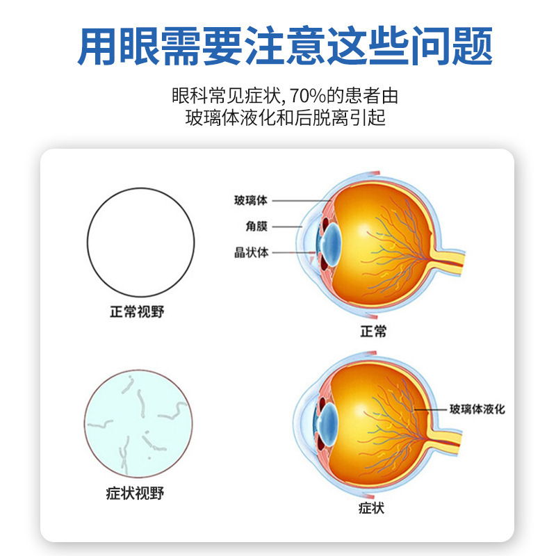 飞蚊专用滴眼液玻璃体混浊可搭配氨碘肽滴眼液重影黑影眼水症状 - 图0