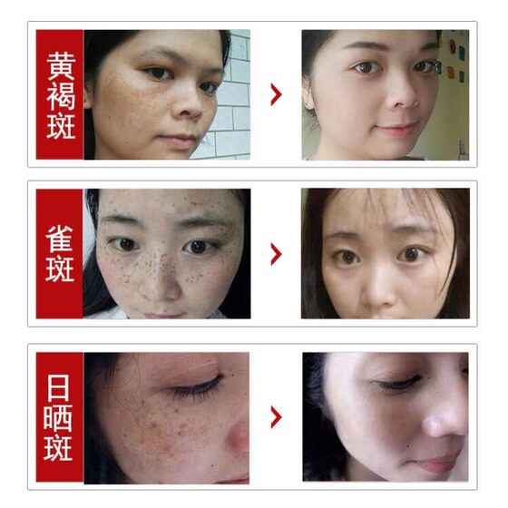 hydroquinone for freckles