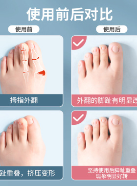 儿童专用五指分离器拇指外翻脚趾