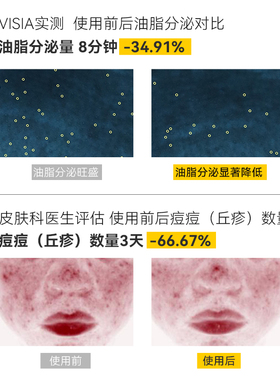 郁美净净颜控油精萃水青少年抗痘祛痘保湿爽肤男女生孩护肤洁面乳