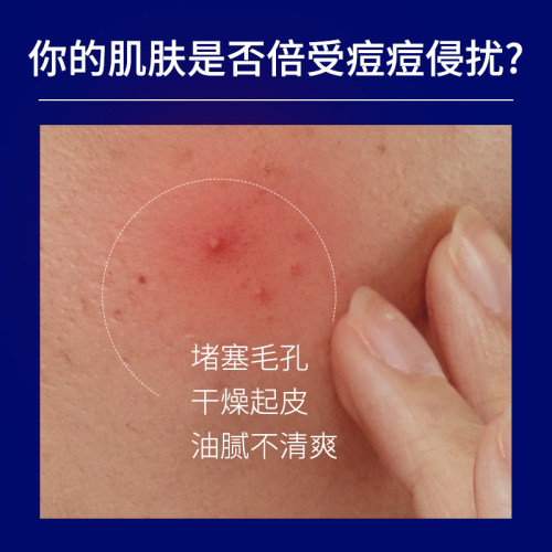 IRY祛痘凝胶 祛痘痘肌专用男士正品官方 - 图0