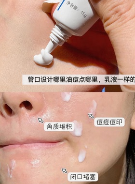 有防伪芙清20%壬二酸清痘精华乳